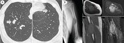 Frontiers Case Report Complete Remission Of Bone Metastasis From